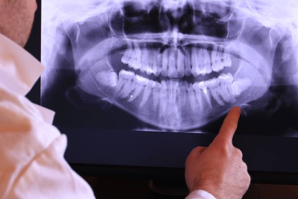 Best Emergency Tooth Extraction in Newark, DE